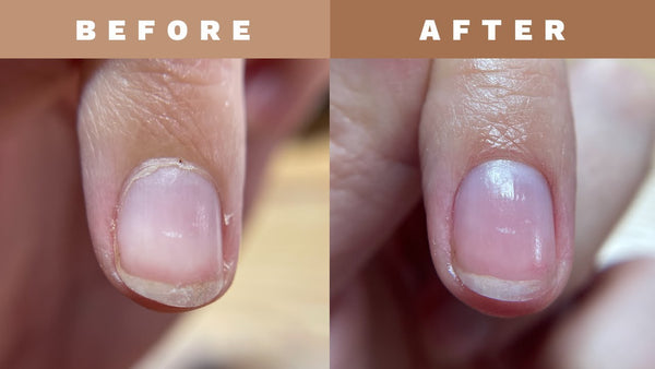 The Ultimate Guide to Brittle Nails: Causes, Consequences, and ...