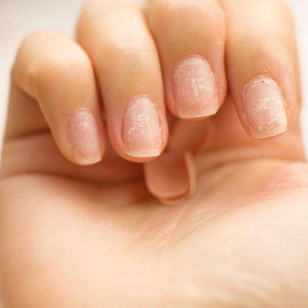 Brittle Nails: Causes and Prevention