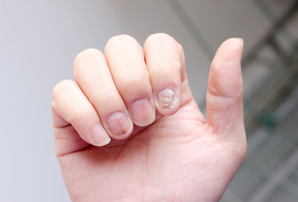 Brittle Nails and Nail Damage: How Recovery RX Can Restore Your Nails to Health