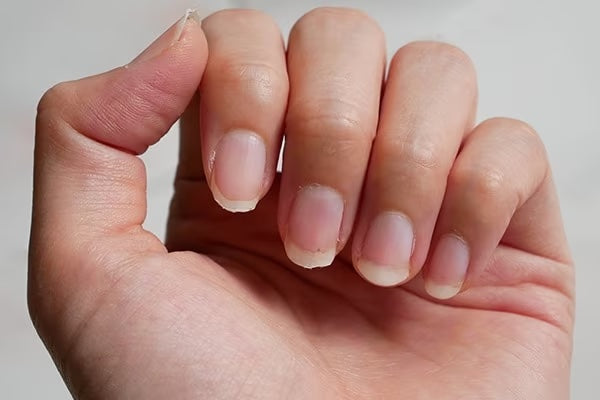 Battling Brittle Nails: Causes, Consequences, and Effective Solutions