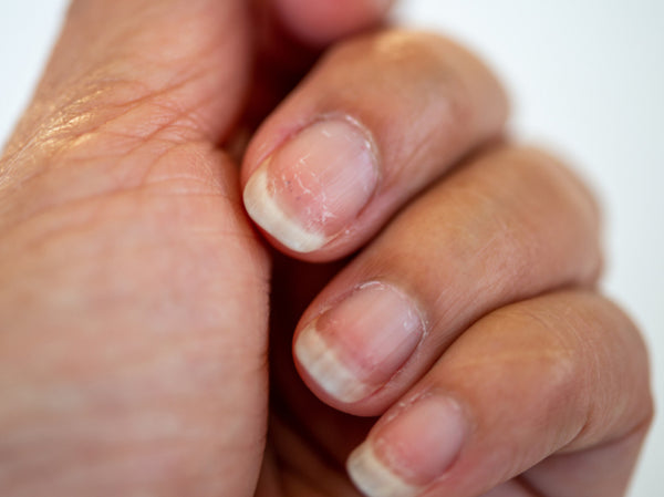 The Top 2 Types of Nail Damage: Causes & Strategies to Repair